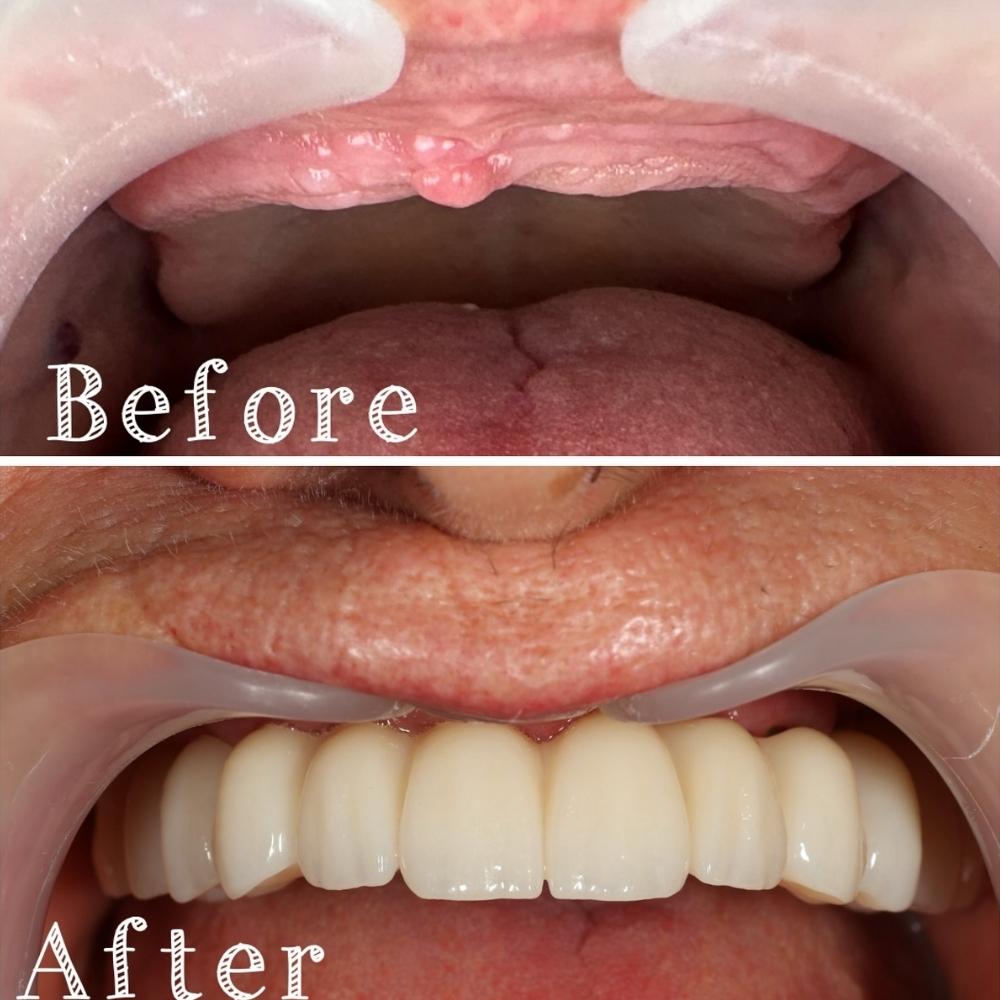 Caz clinic înainte și după implant dentar — reabilitare completă maxilar superior
