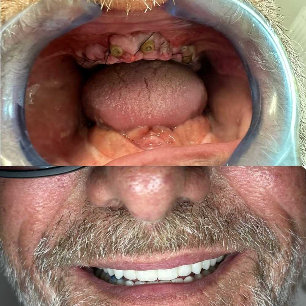 Implant dentar All-on-6 — rezultat estetic natural după tratament complet