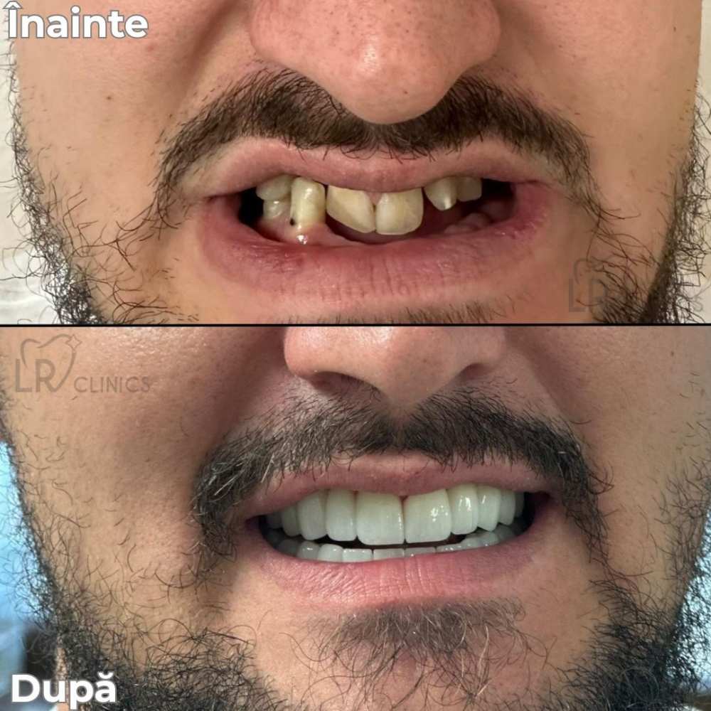 Implant dentar individual — refacerea zâmbetului unui pacient tânăr